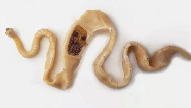 Comment découvrir la présence de parasites dans le corps